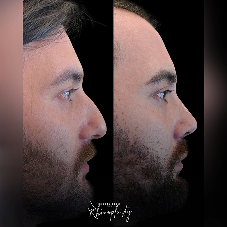 Finding the Right Surgeon for a Rhinoplasty