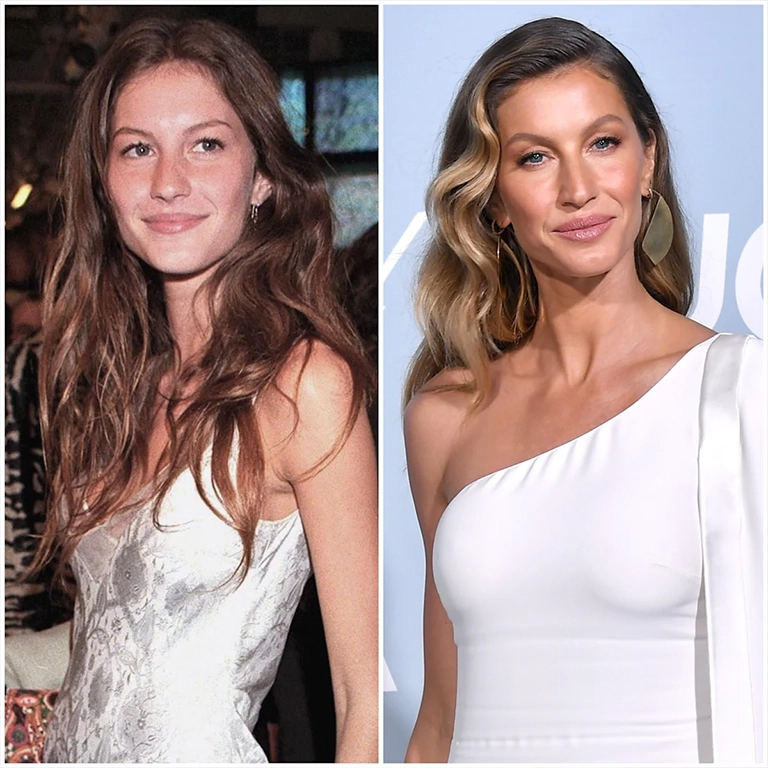 Gisele Bündchen Plastic Surgery A Clinical Analysis