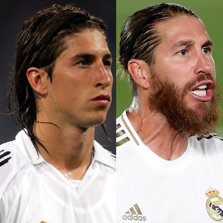 Sergio Ramos Rhinoplasty Before and After