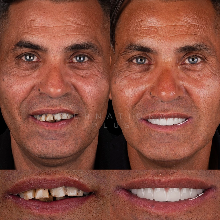 The Benefits of a Smile Transformation