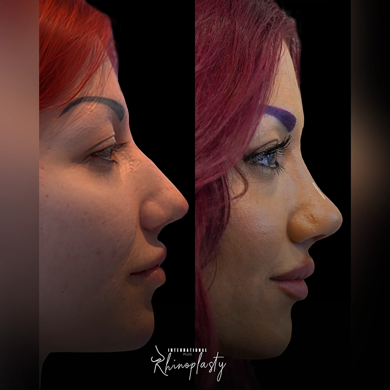 The Best Clinic for a Natural Rhinoplasty
