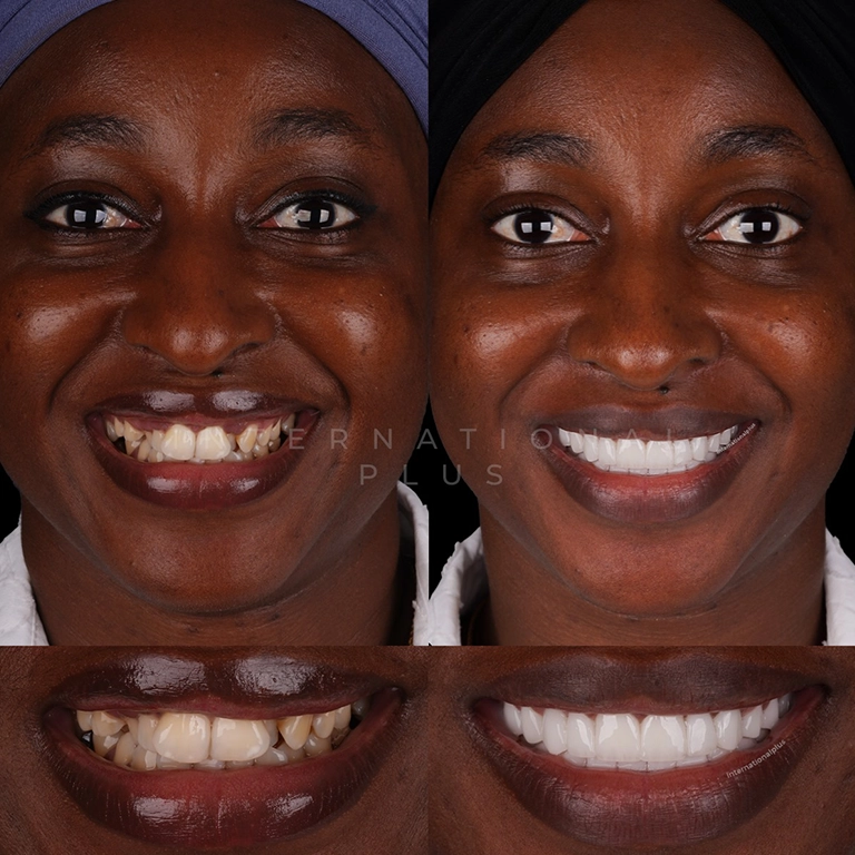 The Best Dental Clinic for a Natural Look