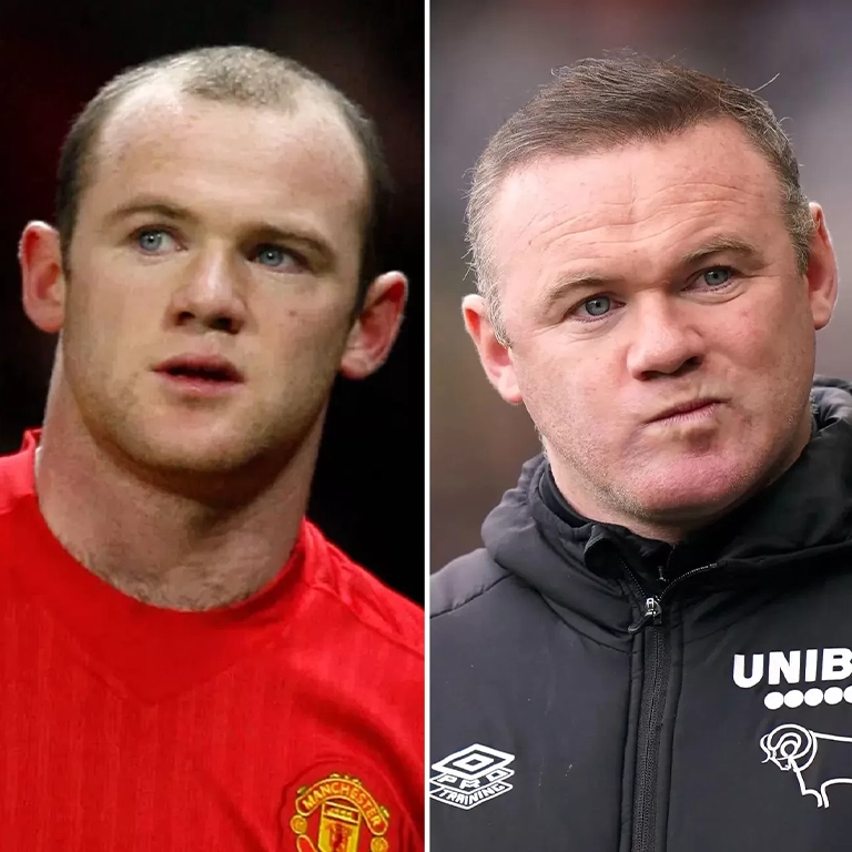 Wayne Rooney Hair Transplant Before and After