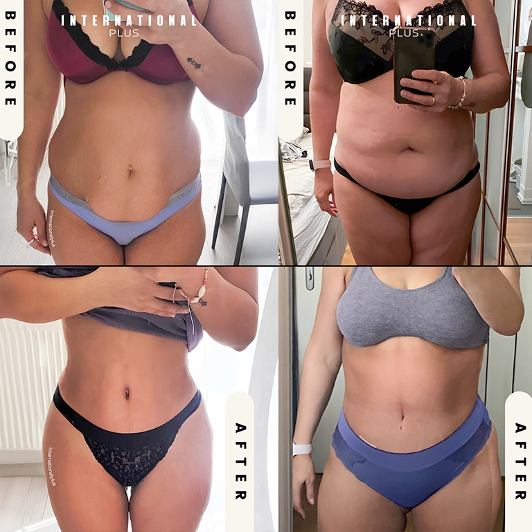 360 Lipo Before and After