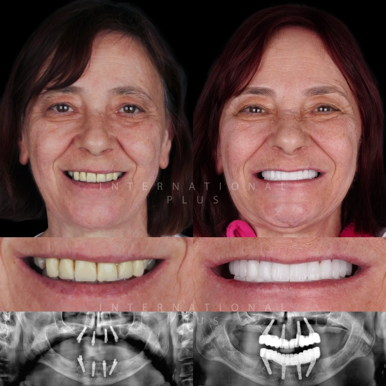 All On 4 Dental Implants Before After