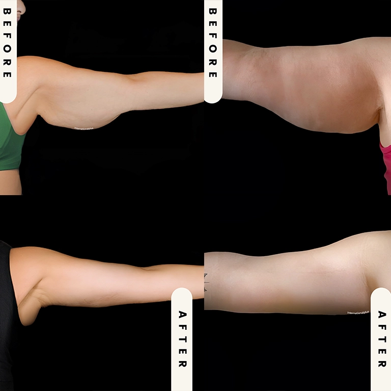 Arm Lift After Major Weight Loss