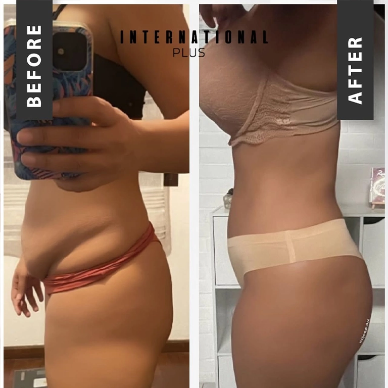 BBL In Turkey Before and After