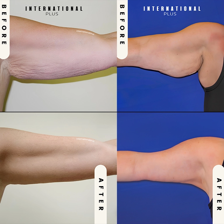 Best Arm Lift Results 2025