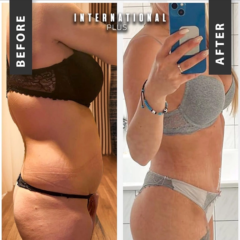 Best Tummy Tuck Results 2025