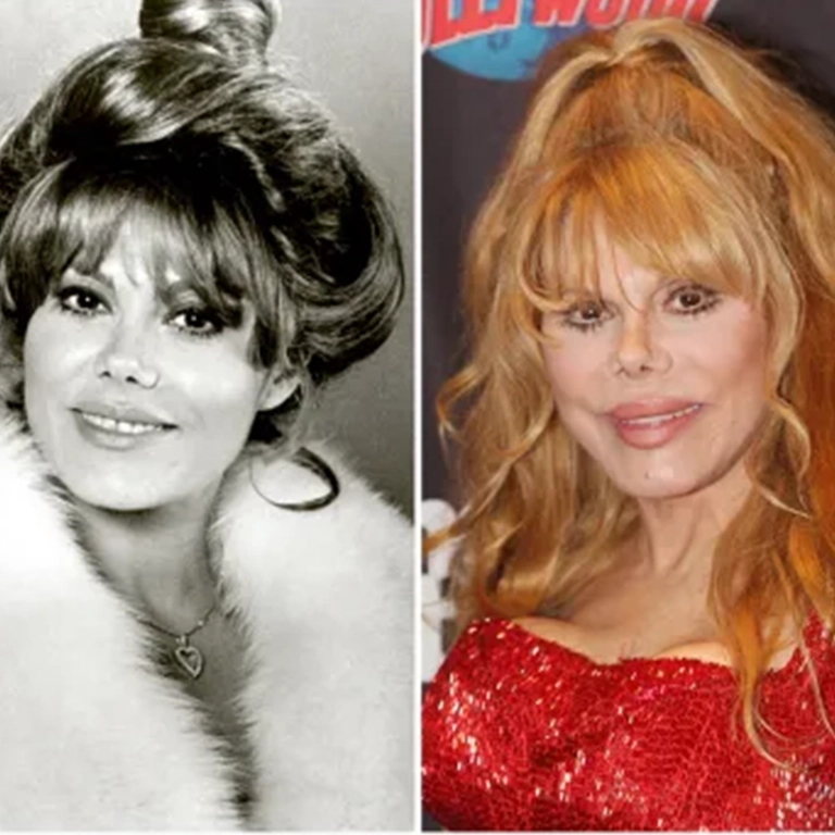 Charo Plastic Surgery Before and After & Charo Before After