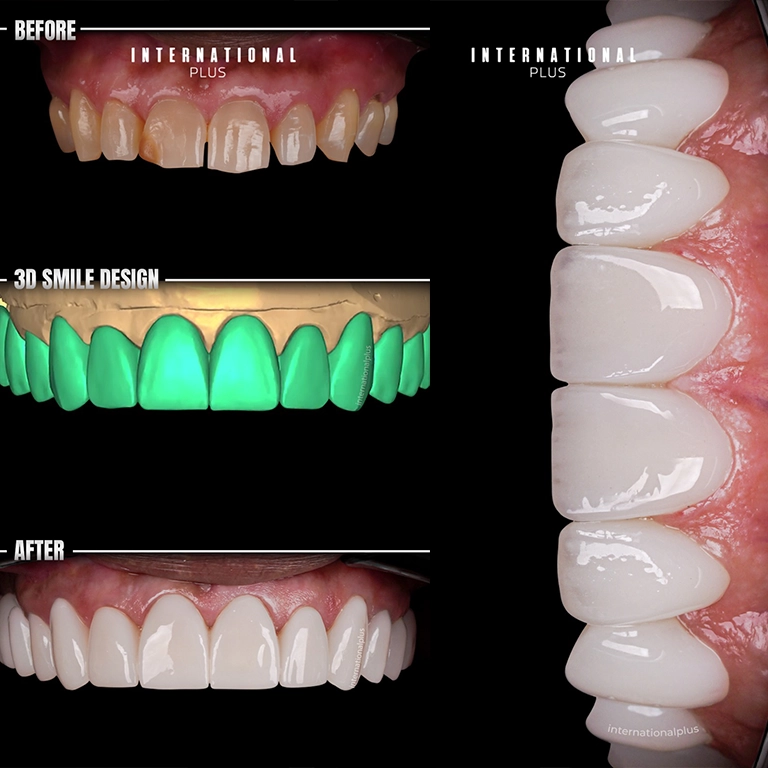 Dental Implant Before After 2025