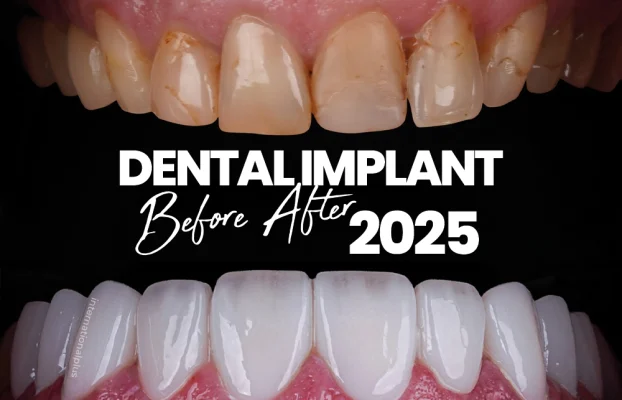 Dental Implants 2025