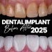 Dental Implants 2025