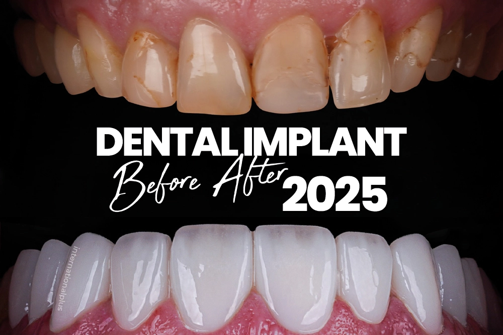 Dental Implants 2025