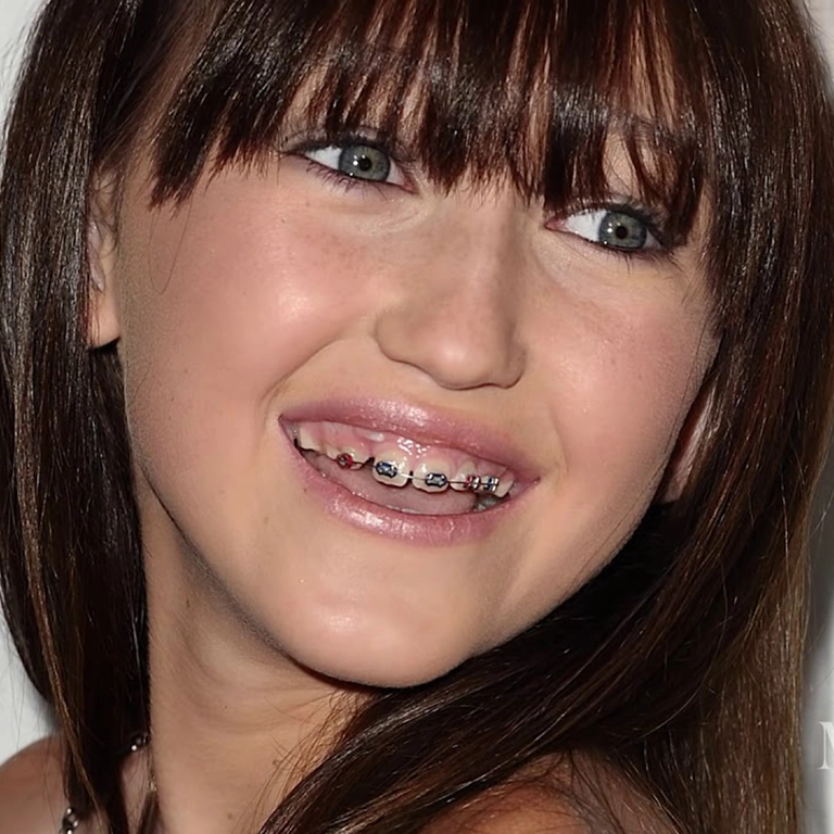Did Noah Cyrus Get Veneers