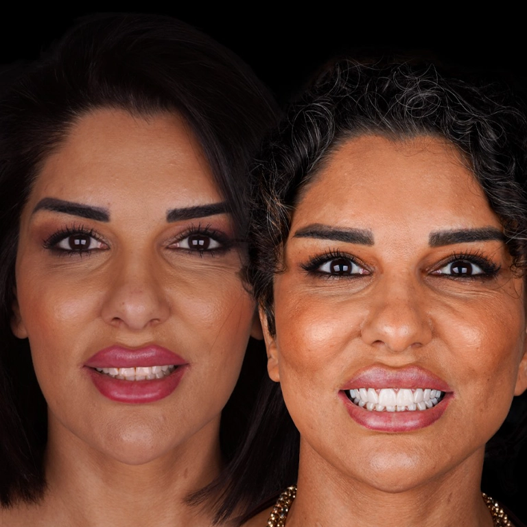 Hollywood Smile Before After 2025