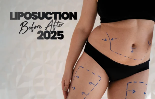 Liposuction 2025 The Ultimate Guide to Advanced Body Sculpting