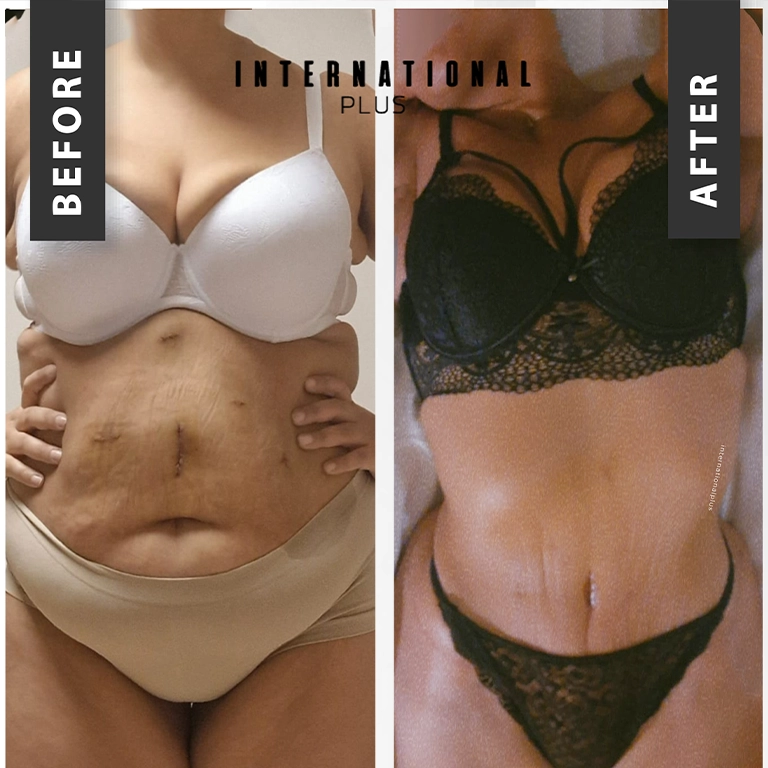 Liposuction Before After 2025