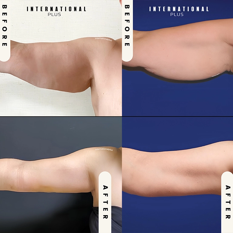 Mini Arm Lift vs Full Arm Lift