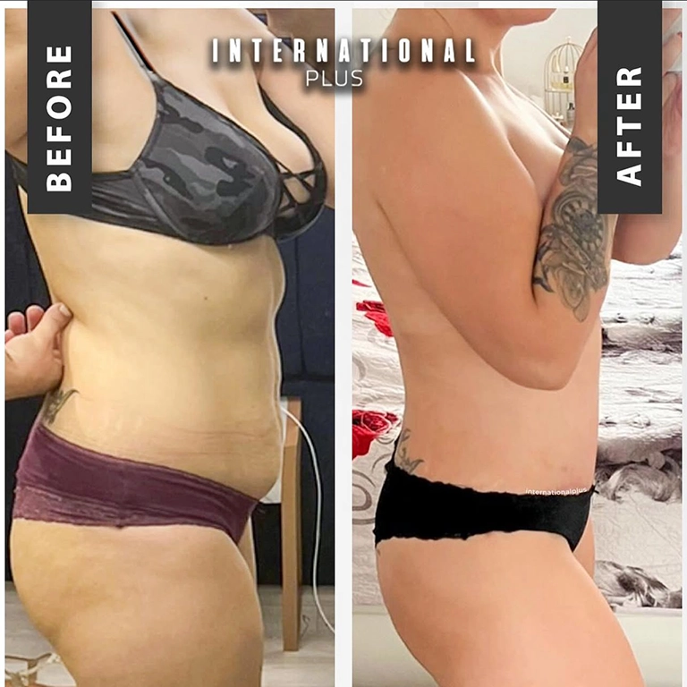 Mommy Makeover Before and After