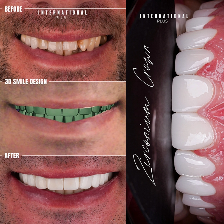 Same Day Dental Implants Before After