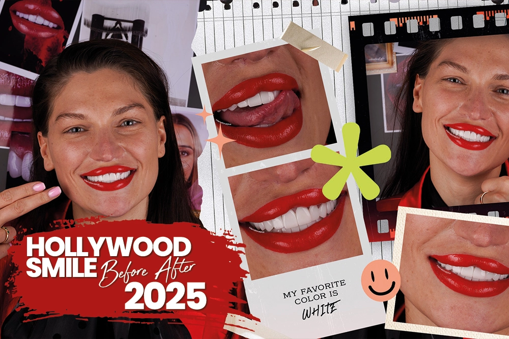 The Ultimate Guide to a Hollywood Smile in 2025
