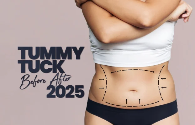 Tummy Tuck 2025