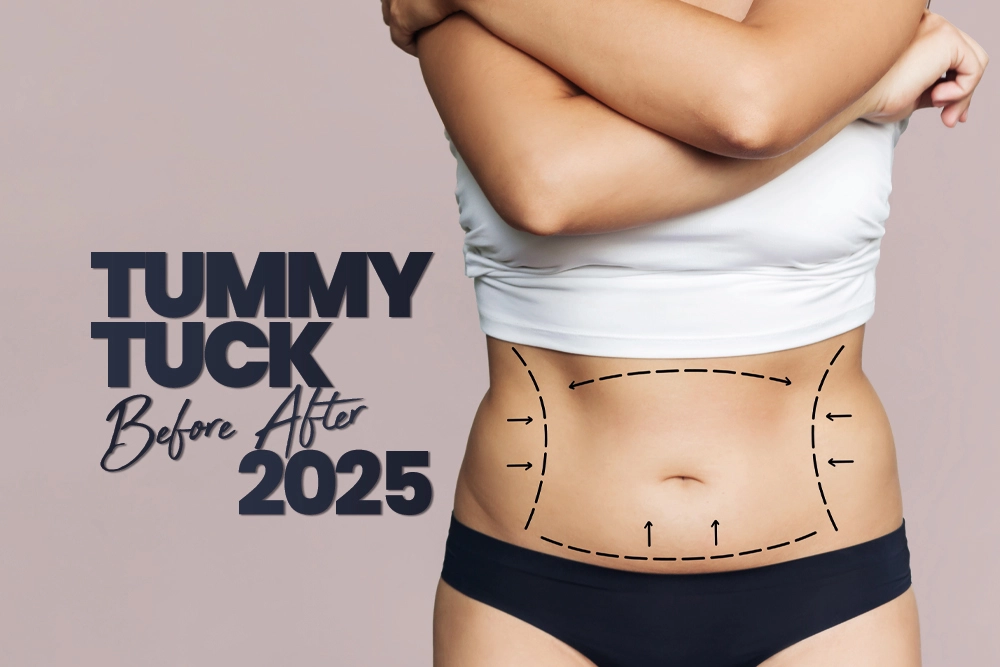 Tummy Tuck 2025