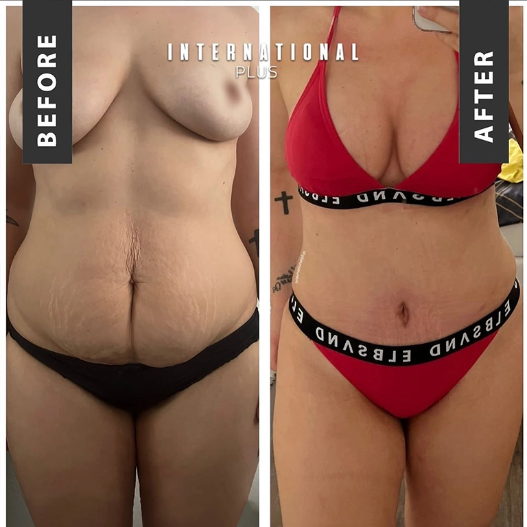 Tummy Tuck Before After 2025