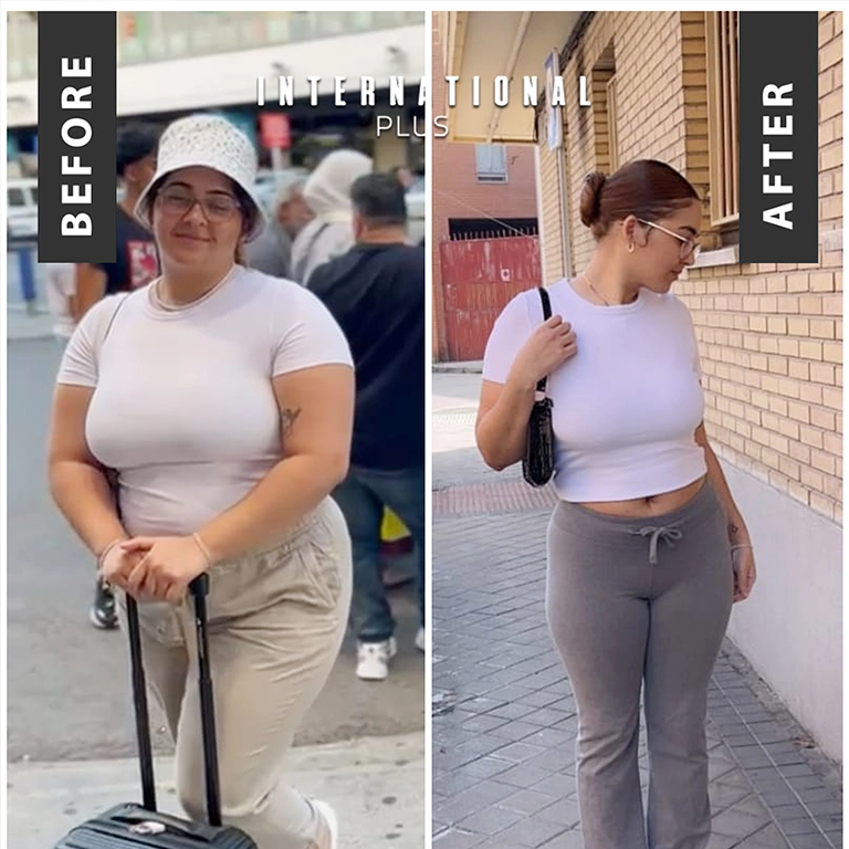 Bariatric Surgery In Turkey