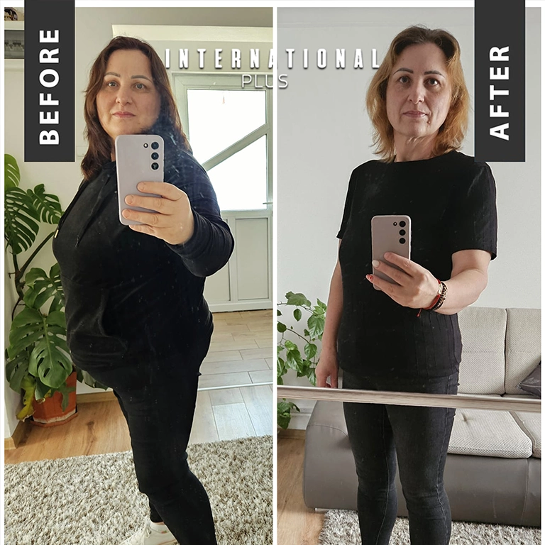 Best Bariatric Surgery Turkey