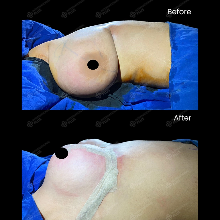 Breast Lift Price Istanbul 2025
