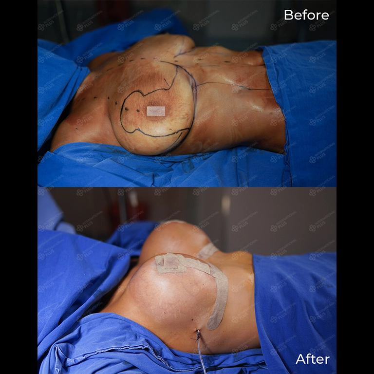 Breast Lift Turkey Reviews