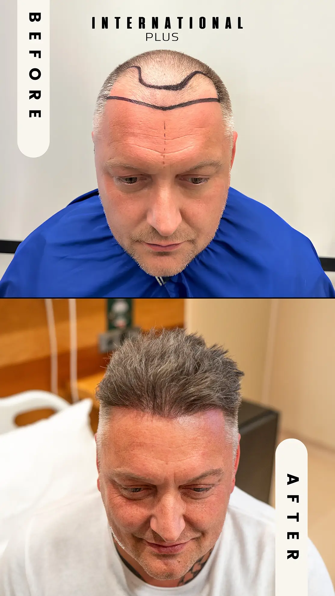 DHI Hair Transplant Before After