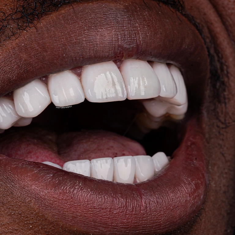 E-max Veneers Istanbul