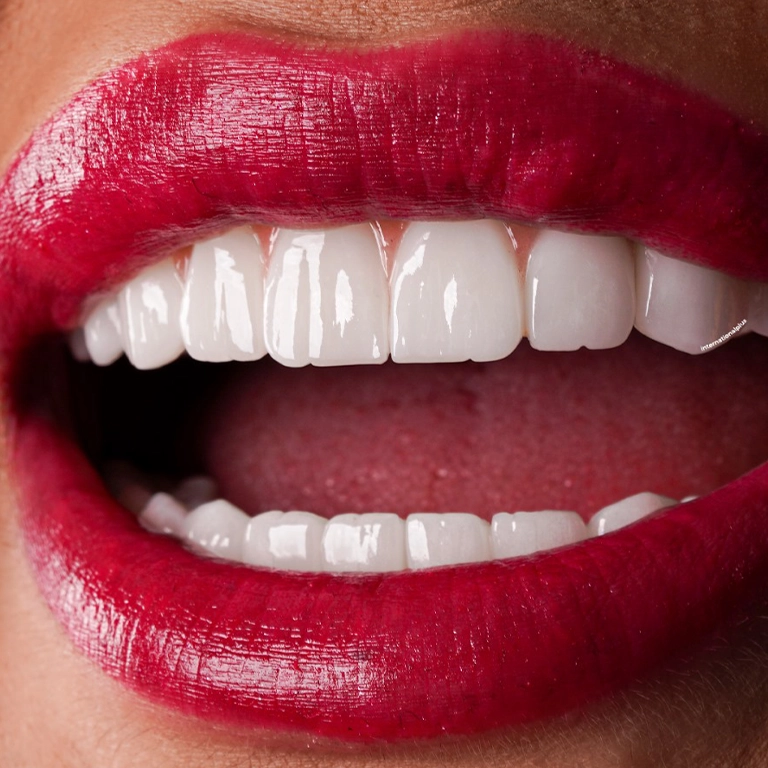 Full Mouth Dental Implants Cost Turkey