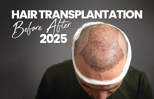 Hair Transplantation Before After 2025