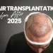 Hair Transplantation Before After 2025