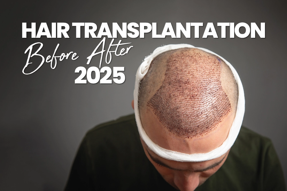 Hair Transplantation Before After 2025