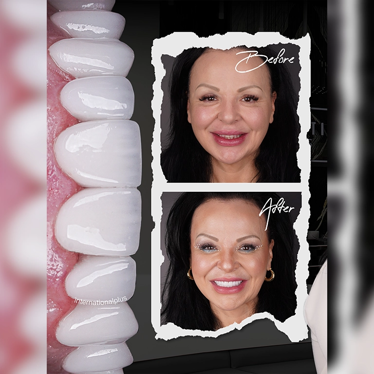 Hollywood Smile E-max Turkey