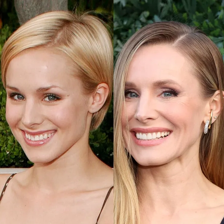 Kristen Bell Teeth Transformation
