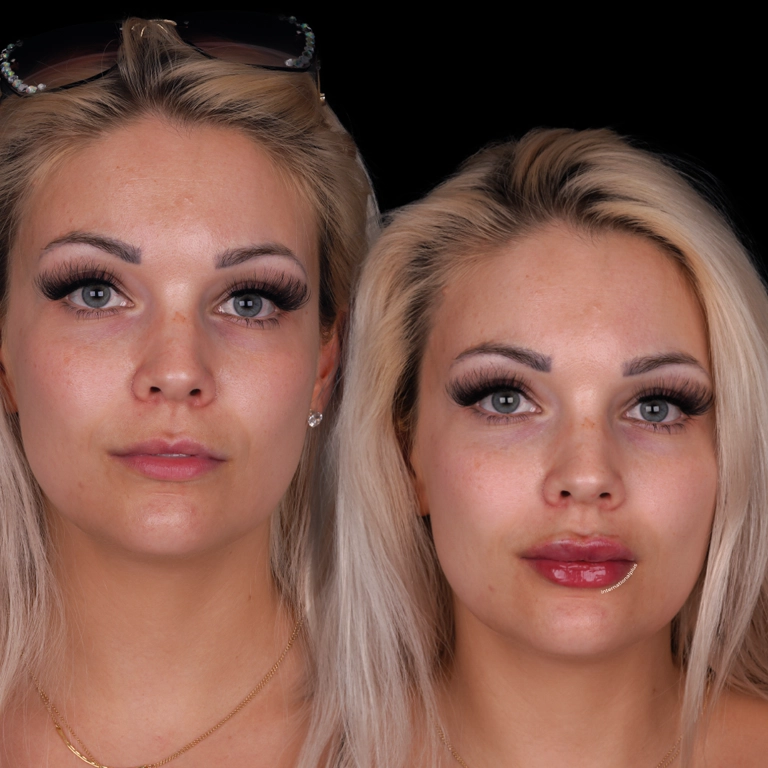 Laser Treatments Before After