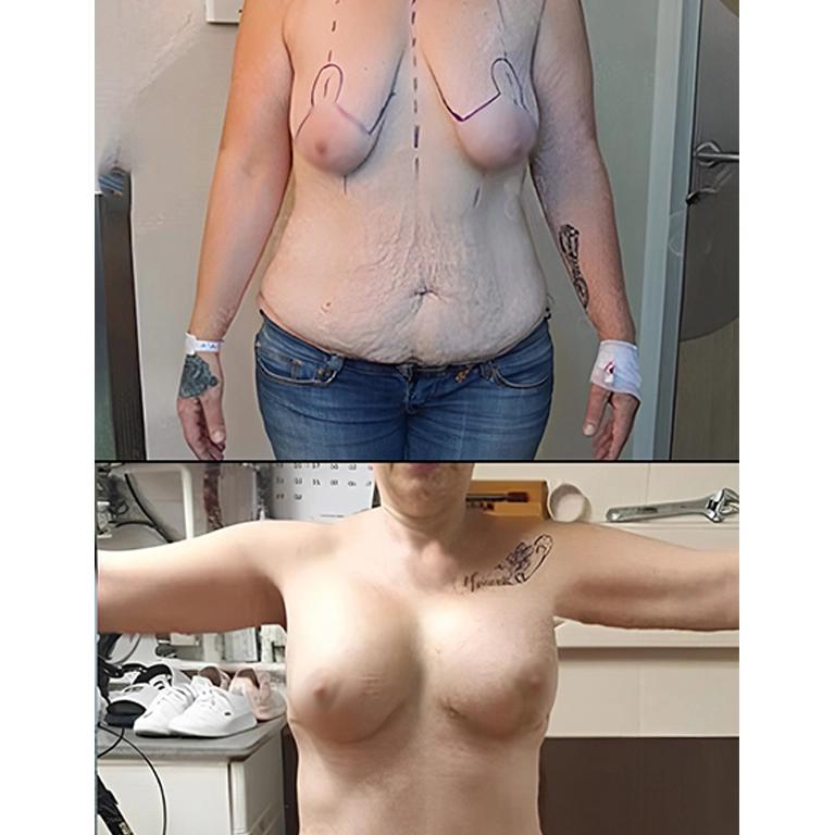 Mastopexy Cost Turkey