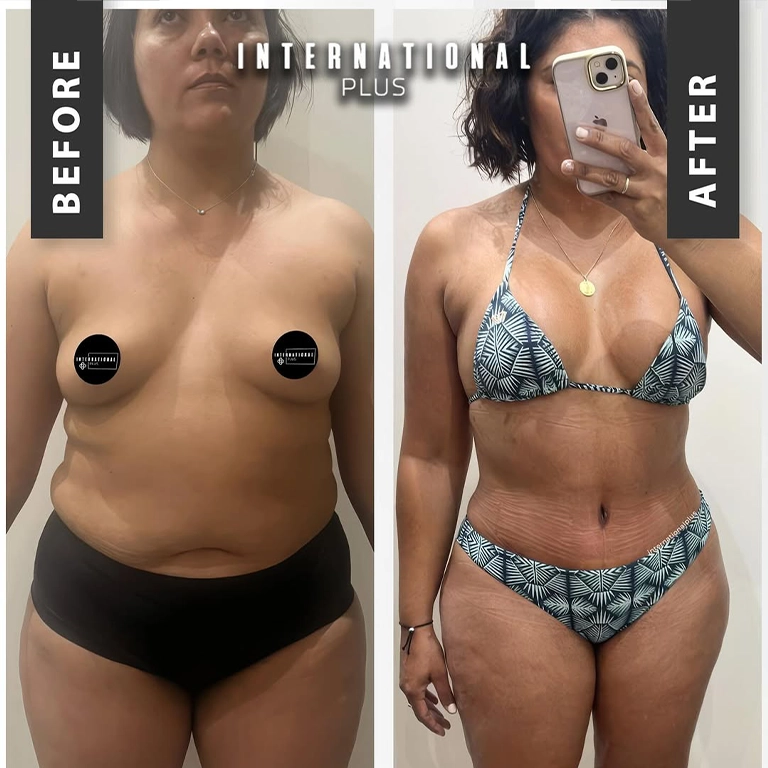 360 Body Lift Explained