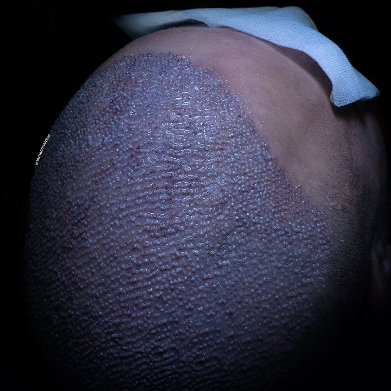 5000 Grafts Before After