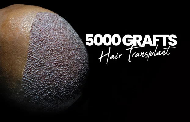 5000 Grafts Hair Transplant