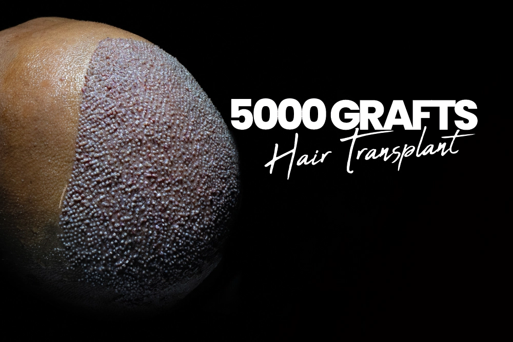 5000 Grafts Hair Transplant