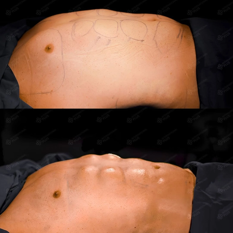 Abdominal Etching Cost 2026