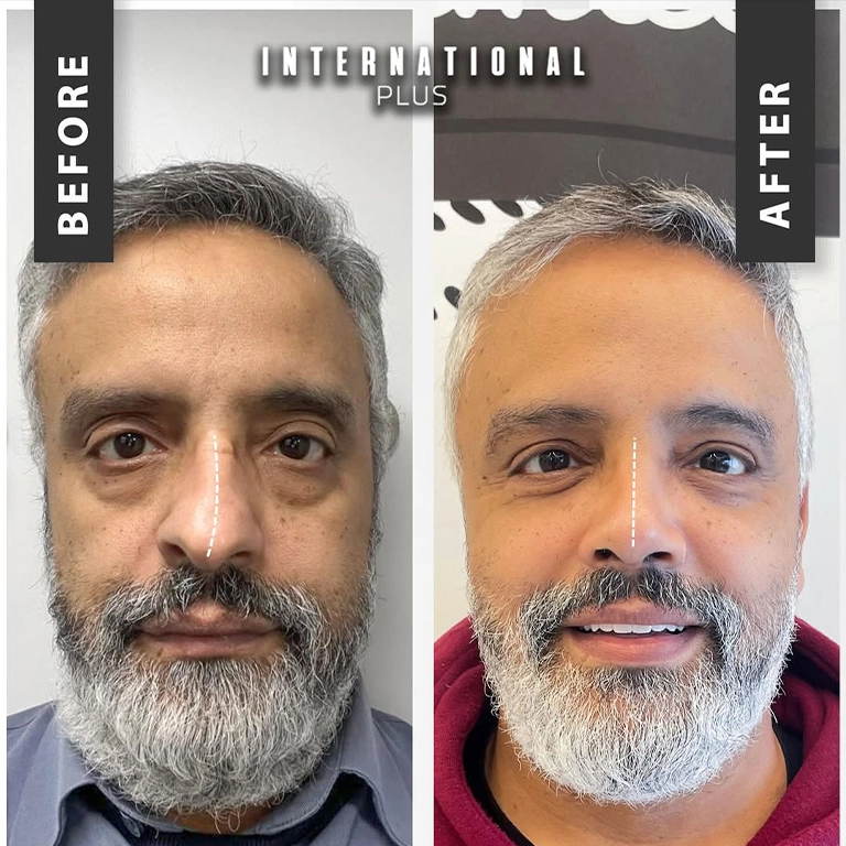 African American Rhinoplasty Turkey