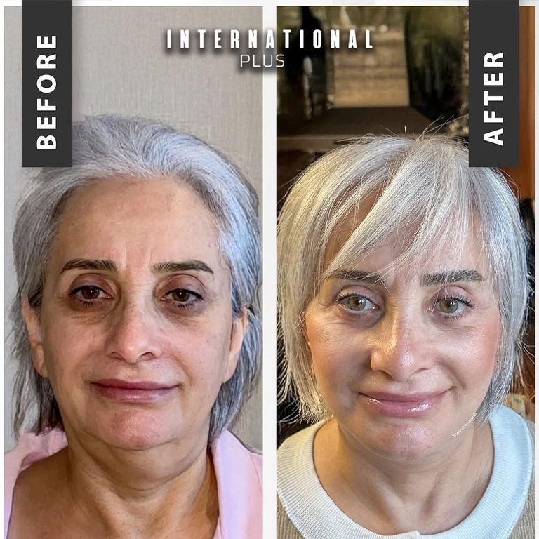 Asian Blepharoplasty Turkey
